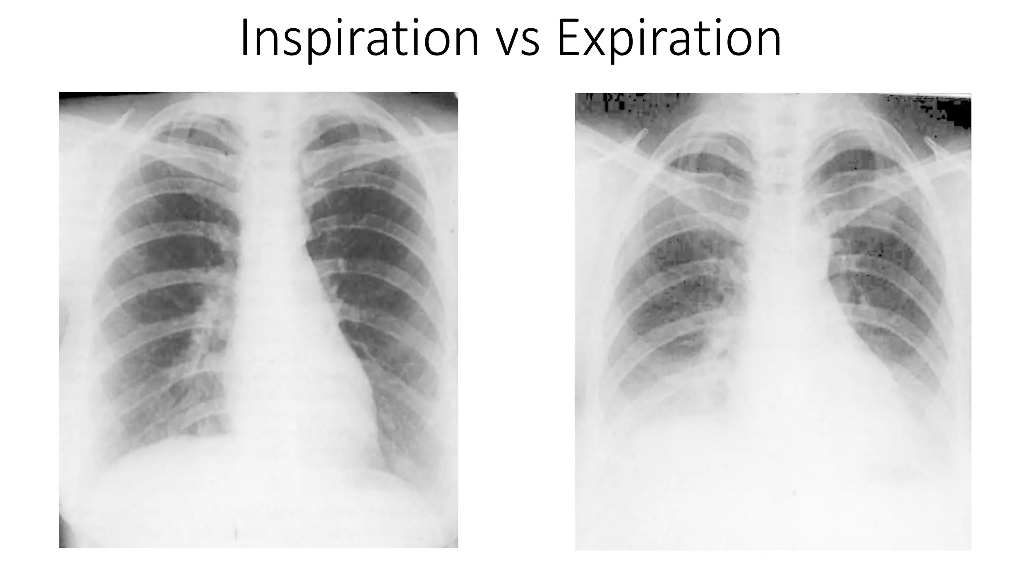 Gambar Rontgen Interpretasi Rontgen Dada atau Foto Thoraks | PDF