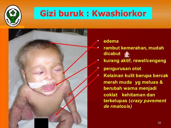 Materi ii gejala klinis gizi buruk Materi ii gejala klinis gizi buruk