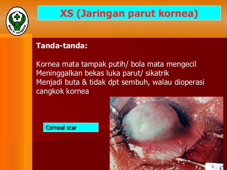 Materi ii gejala klinis gizi buruk Materi ii gejala klinis gizi buruk