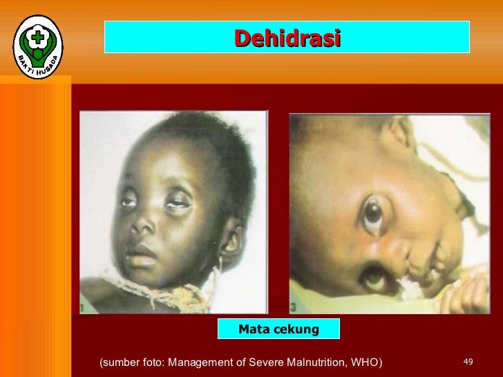 Materi ii gejala klinis gizi buruk