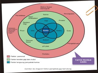FAKTOR PENYEBAB
KARIES
 