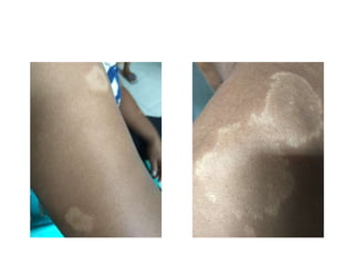 materi penyakit kusta untuk orang awam indonesia | PPT