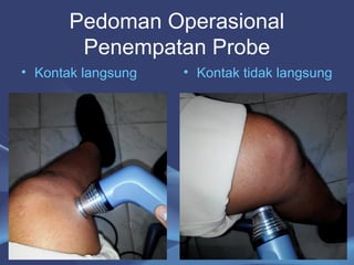 Pedoman Operasional 
Penempatan Probe 
• Kontak langsung • Kontak tidak langsung 
28 
 