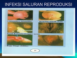 INFEKSI SALURAN REPRODUKSI
 