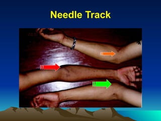 Needle Track
 