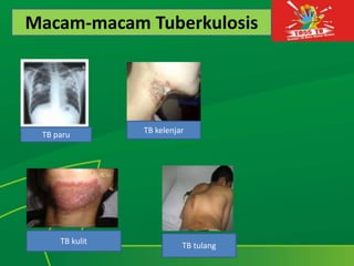 Macam-macam Tuberkulosis
TB paru
TB kelenjar
TB kulit
TB tulang
 