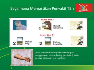 Bagaimana Memastikan Penyakit TB ?
Untuk memastikan TB pada anak dengan
menggunakan sistem skoring (penilaian), salah
satunya dilakukan test mantoux
 