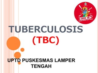 TUBERCULOSIS
(TBC)
UPTD PUSKESMAS LAMPER
TENGAH
 
