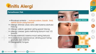 Pemeriksaan Fisik
•• Rinoskopi anterior 🡪 mukosa edem, basah, livid,
sekret encer yang banyak
•• Allergic Shinner: stasis vena oleh karena obstruksi
hidung
•• Allergic sallute: gerakan sering gosok hidung
•• Allergic crease: garis melintang dorsum nasi 1/3
bawah
•• Facies adenoid: karena mulut sering terbuka
•• Cobblestone appearance: dinding post faring
granuler dan edema
•• Geographic tongue
Rinitis Alergi
130
Allergic Shinner
Allergic Salute
Allergic Crease
4
A
 