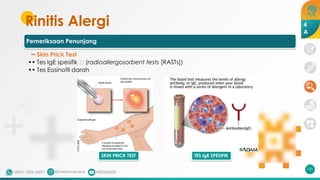Rinitis Alergi
Pemeriksaan Penunjang
•• Skin Prick Test
•• Tes IgE spesifik 🡪 (radioallergosorbent tests [RASTs])
•• Tes Eosinofil darah
131
TES IgE SPESIFIK
SKIN PRICK TEST
4
A
 