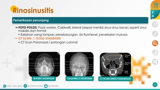 Rinosinusitis
Pemeriksaan penunjang
•• FOTO POLOS: Posisi waters, Caldwell, lateral (dapat menilai sinus-sinus besar) seperti sinus
maksila dan frontal
• Kelainan yang tampak: perselubungan, air fluid level, penebalan mukosa
•• CT SCAN: 🡪 GOLD STANDARD
• CT Scan Paranasal / potongan coronal
139
WATER’S RONTGEN CALDWELL’S RONTGEN CT SCAN SINUS PARANASAL
3
A
2
 
