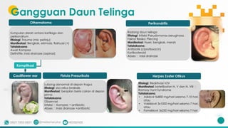 Gangguan Daun Telinga
Othematoma Perikondritis
Fistula Preaurikula
Kumpulan darah antara kartilago dan
perikondrium
Etiologi: Trauma (mis: petinju)
Manifestasi: Bengkak, ekimosis, fluktuasi (+)
Tatalaksana:
Awal: Kompres
Definitife: insisi drainase (aspirasi)
Radang daun telinga
Etiologi: Infeksi Pseudomonas aeruginosa
Faktor Resiko: Piercing
Manifestasi: Nyeri, bengkak, merah
Tatalaksana:
Antibiotik (ciprofloxacin)
Kortikosteroid
Abses 🡪 insisi drainase
Lubang abnormal di depan tragus
Etiologi: sisa arkus brakialis
Manifestasi: benjolan berisi cairan di depan
pinna
Tatalaksana:
Observasi
Infeksi 🡪 Kompres + antibiotic
Abses 🡪 Insisi drainase +antibiotic
Cauliflower ear
Komplikasi
Herpes Zoster Otikus
Etiologi: Reaktivasi VZV
Manifestasi: keterlibatan N. V dan N. VIII 🡪
Ramsay Hunt Syndrome
Tatalaksana:
• Asiklovir 5x800 mg/hari selama 7-10 hari,
atau
• Valsiklovir 3x1000 mg/hari selama 7 hari,
atau
• Famsiklovir 3x250 mg/hari selama 7 hari
 