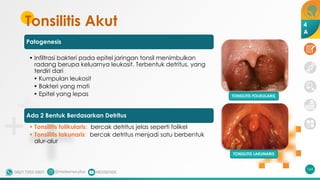Tonsilitis Akut
Patogenesis
• Infiltrasi bakteri pada epitel jaringan tonsil menimbulkan
radang berupa keluarnya leukosit. Terbentuk detritus, yang
terdiri dari
• Kumpulan leukosit
• Bakteri yang mati
• Epitel yang lepas
Ada 2 Bentuk Berdasarkan Detritus
• Tonsilitis folikularis: bercak detritus jelas seperti folikel
• Tonsilitis lakunaris: bercak detritus menjadi satu berbentuk
alur-alur
164
TONSILITIS FOLIKULARIS
TONSILITIS LAKUNARIS
4
A
 
