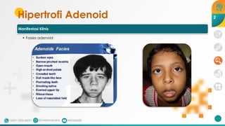 Hipertrofi Adenoid
Manifestasi Klinis
• Fasies adenoid
2
 