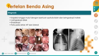 Tertelan Benda Asing
Diagnosis
• Inspeksi rongga mulut dengan bantuan spatula lidah dan laringoskopi indirek
• Laringoskopi direk
• Endoskopi
• Foto polos leher AP dan lateral
191
3
B
 