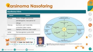 Karsinoma Nasofaring
199
Lokasi Gejala
Telinga Tinitus, otalgia, penurunan
pendengaran, rasa penuh di
telinga
Hidung Epistaksis, post nasal drip,
sumbatan jalan napas
Mata Diplopia, lakrimasi, nyeri wajah
Leher Pembengkakan pada KGB
Manifestasi Klinis
Diplopia
“N E N E” = Nose Ear Neck Eye
MED+
EASY
 
