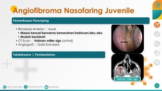 Angiofibroma Nasofaring Juvenile
202
Holman miller sign
Pemeriksaan Penunjang
• Rinoskopi Anterior 🡪 Awal
• Massa kenyal berwarna kemerahan/kebiruan/abu-abu
• Mudah berdarah
• CT-Scan 🡪 Holman miller sign (antral)
• Angiografi 🡪 Gold Standard
Tatalaksana 🡪 Pembedahan
 
