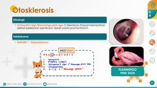 Otosklerosis
FLAMMINGO
PINK SIGN
Otoskopi
• Schwarte’s sign/flammingo pink sign 🡪 Membran timpani kemerahan
akibat pelebaran pembuluh darah pada promontorium
Tatalaksana
• Definitif 🡪 Stapedektomi
47
MED+
EASY
3
A
 