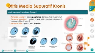 Otitis Media Supuratif Kronis
Letak perforasi membran timpani
• Perforasi sentral 🡪 pada pars tensa dengan tepi masih utuh
• Perforasi marginal 🡪 terjadi di tepi sehingga berhubungan langsung
dengan siklus timpanik
• Perforasi atik 🡪 pada pars flaksida
63
3
A
 