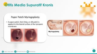 Otitis Media Supuratif Kronis
67
 