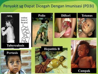 Penyakit yg Dapat Dicegah Dengan Imunisasi (PD3I)
Tuberculosis
Polio Tetanus
Pertusis
Campak
Difteri
Hepatitis B
 
