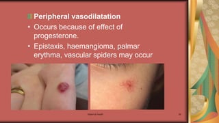 Maternal health 38
Peripheral vasodilatation
• Occurs because of effect of
progesterone.
• Epistaxis, haemangioma, palmar
erythma, vascular spiders may occur
 