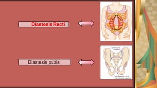 Diastesis Recti
Diastesis pubis
 