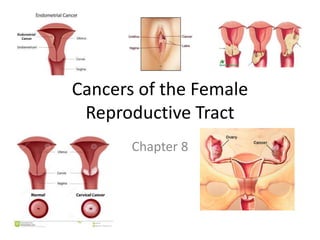 Cancers of the Female
Reproductive Tract
Chapter 8
 