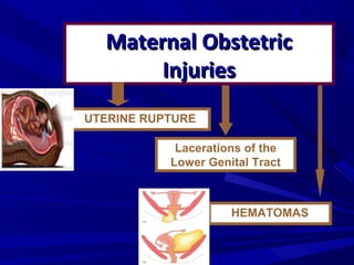 Maternal ObstetricMaternal Obstetric
InjuriesInjuries
Lacerations of the
Lower Genital Tract
HEMATOMAS
UTERINE RUPTURE
 