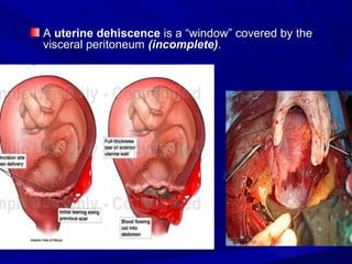 AA uterine dehiscenceuterine dehiscence is a “window” covered by theis a “window” covered by the
visceral peritoneumviscer...