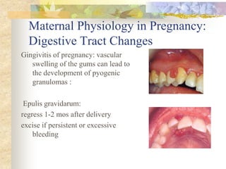 Maternal Physiology in Pregnancy: Digestive Tract ChangesGingivitis of pregnancy: vascular swelling of the gums can lead to the development of pyogenic granulomas : Epulis gravidarum: regress 1-2 mos after deliveryexcise if persistent or excessive bleeding 