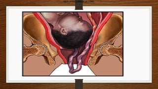 •PROLAPSED UMBILICAL CORD –
ough
 