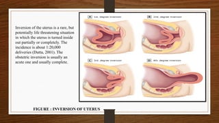 Inversion of the uterus is a rare, but
potentially life threatening situation
in which the uterus is turned inside
out partially or completely. The
incidence is about 1:20,000
deliveries (Dutta, 2001). The
obstetric inversion is usually an
acute one and usually complete.
FIGURE : INVERSION OF UTERUS
 