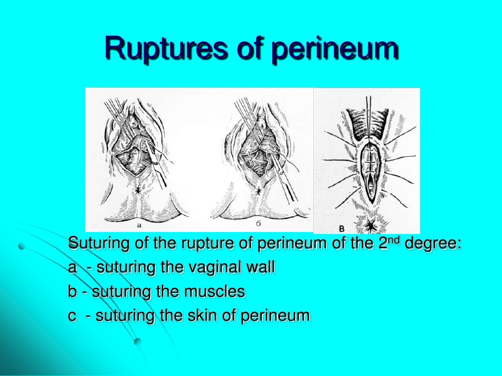 Maternal trauma. obstetric surgeries