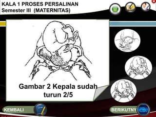 KALA 1 PROSES PERSALINAN
Semester III (MATERNITAS)
Gambar 2 Kepala sudah
turun 2/5
BERIKUTNYAKEMBALI
 