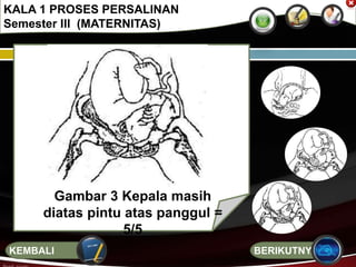 KALA 1 PROSES PERSALINAN
Semester III (MATERNITAS)
Gambar 3 Kepala masih
diatas pintu atas panggul =
5/5
BERIKUTNYAKEMBALI
 