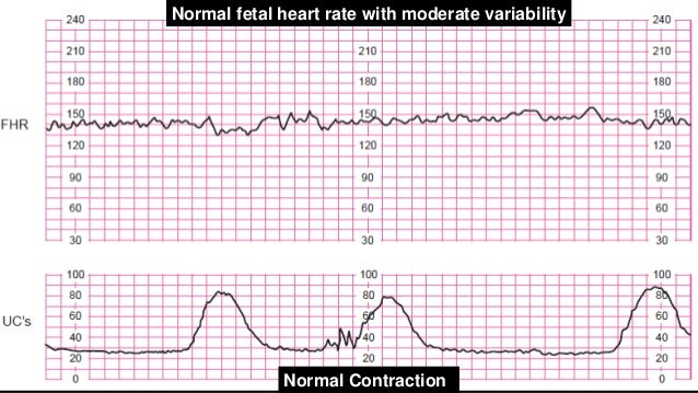 baby heartbeat and contraction monitor