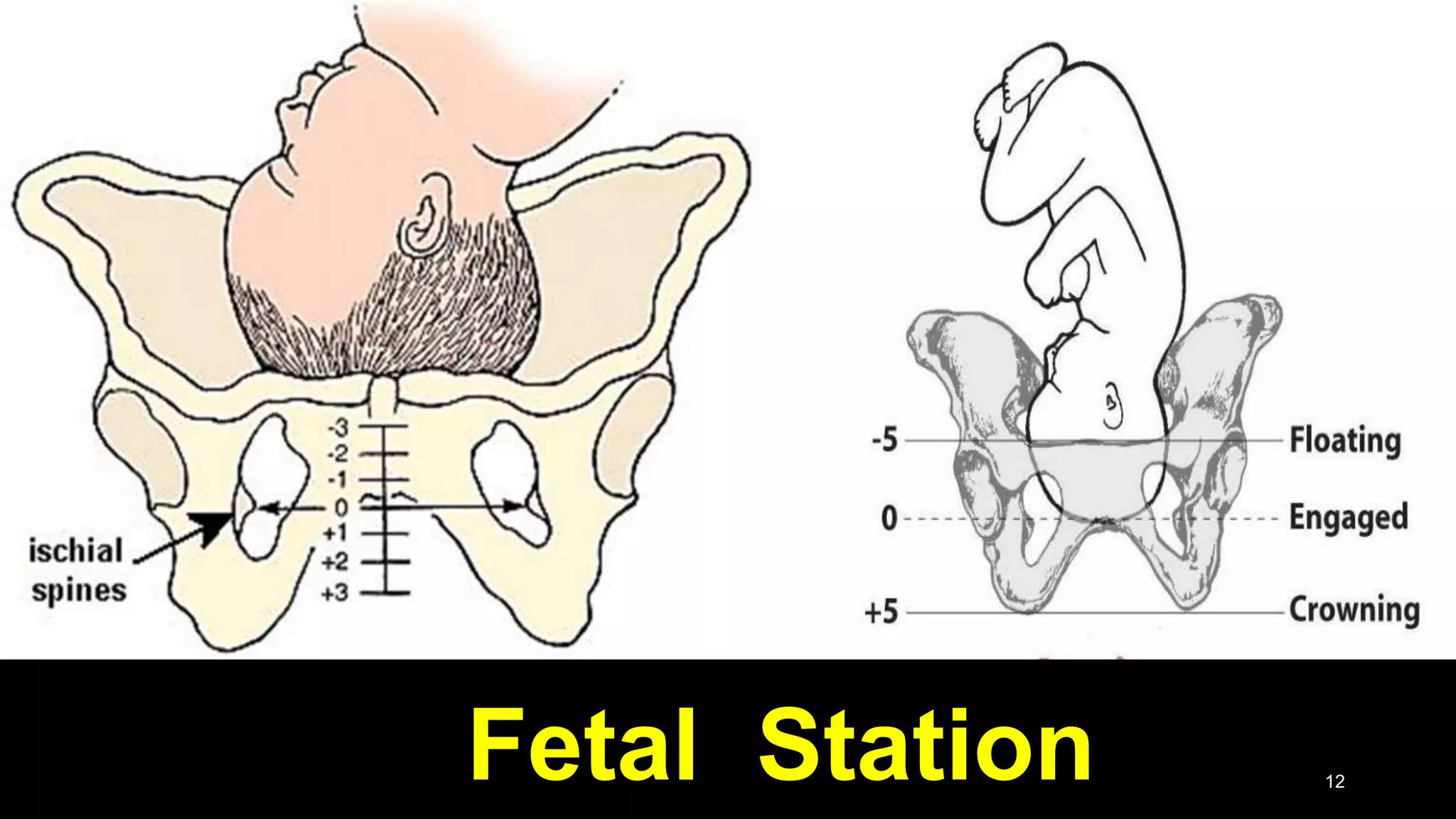 Fetal Station 12
 