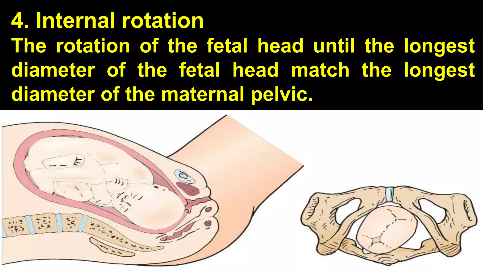 4. Internal rotation
The rotation of the fetal head until the longest
diameter of the fetal head match the longest
diameter of the maternal pelvic.
22
 