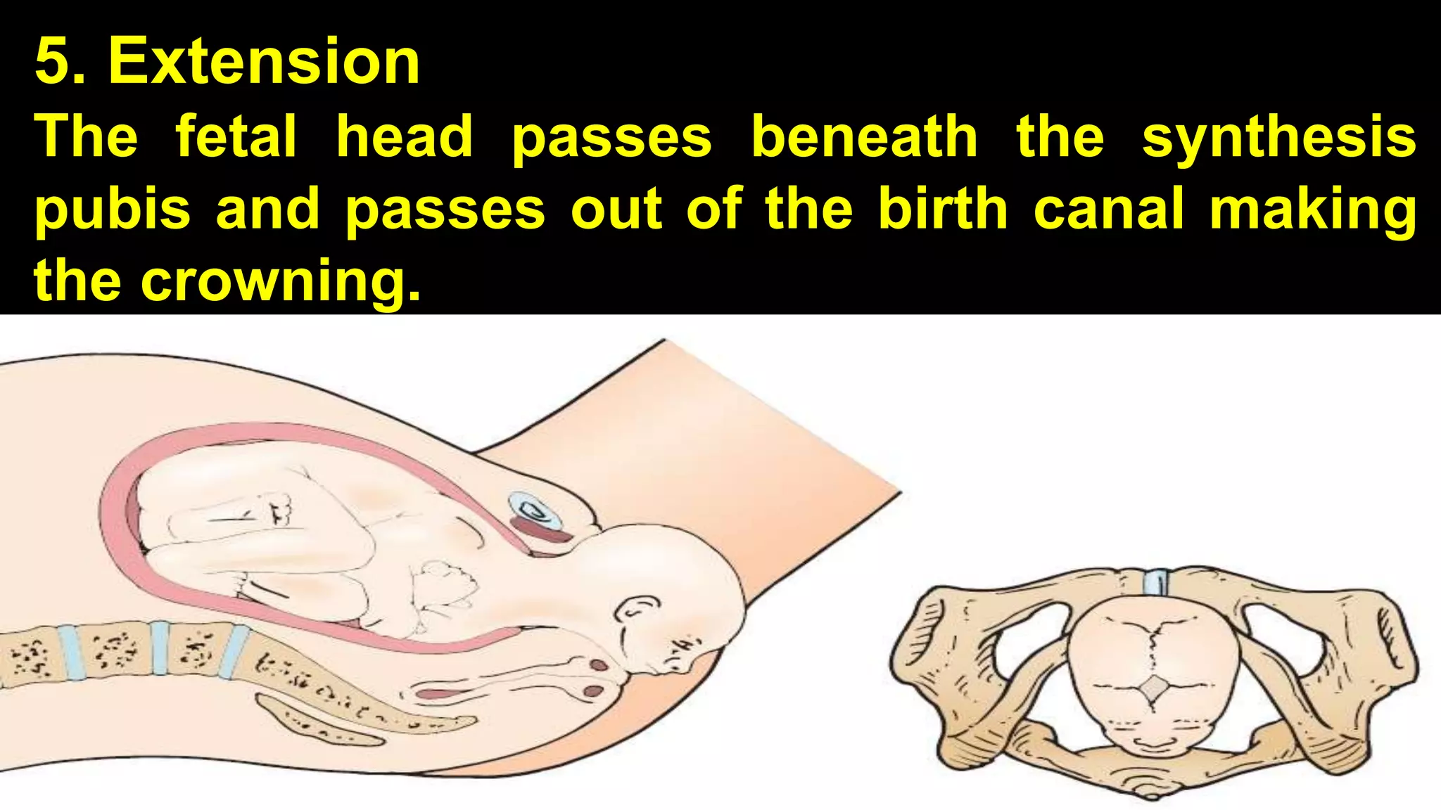 5. Extension
The fetal head passes beneath the synthesis
pubis and passes out of the birth canal making
the crowning.
23
 