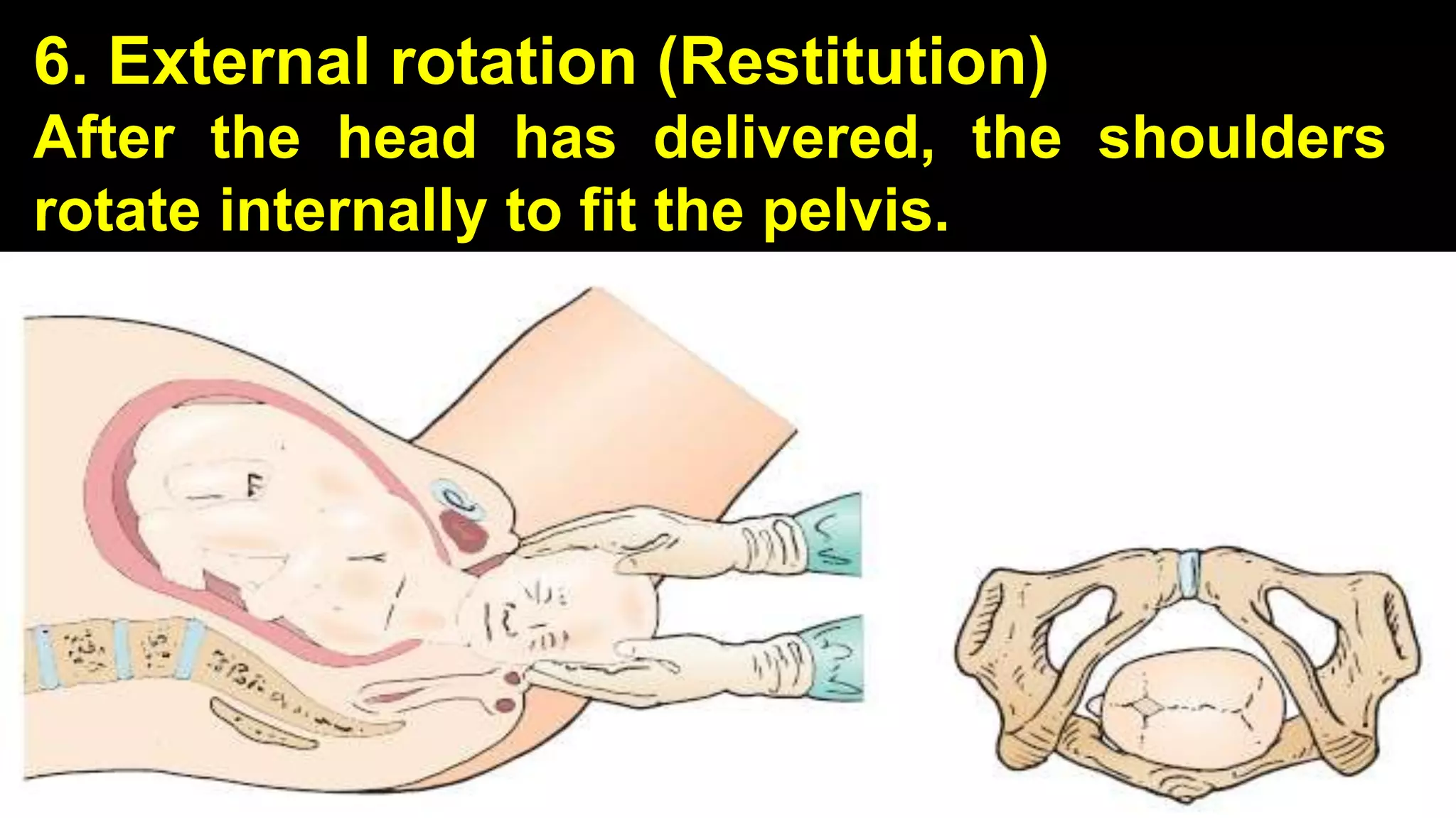 6. External rotation (Restitution)
After the head has delivered, the shoulders
rotate internally to fit the pelvis.
24
 