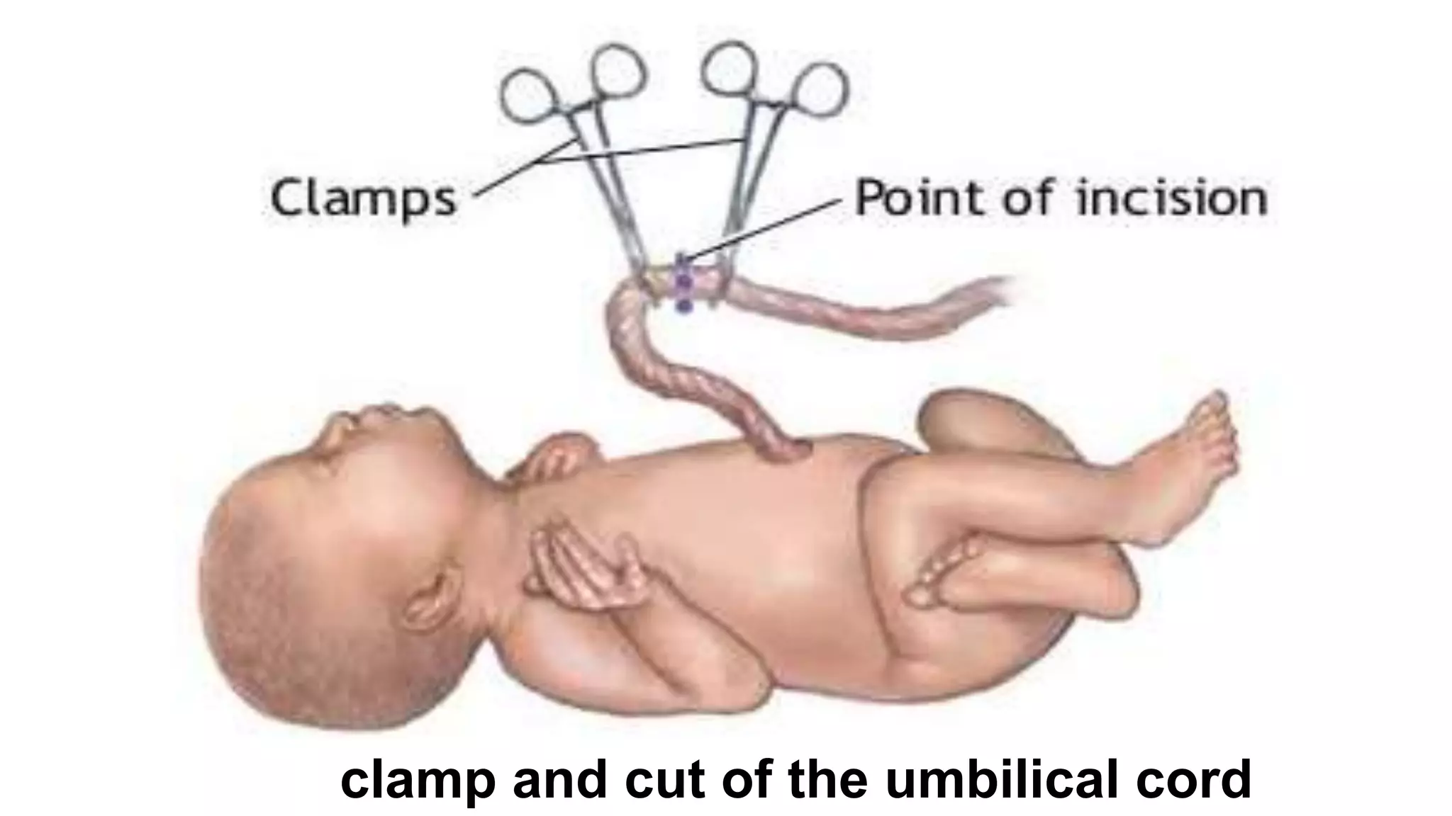 34
clamp and cut of the umbilical cord
 