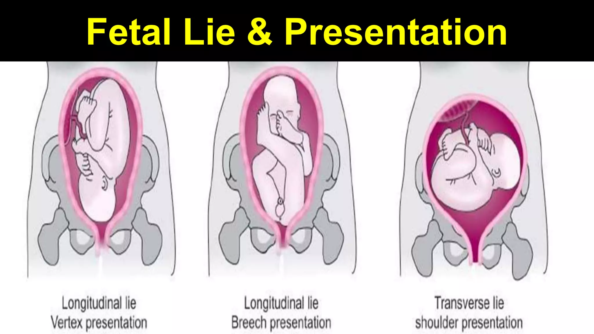 9
Fetal Lie & Presentation
 