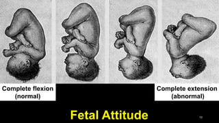 Fetal Attitude 10
Complete extension
(abnormal)
Complete flexion
(normal)
 