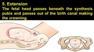 5. Extension
The fetal head passes beneath the synthesis
pubis and passes out of the birth canal making
the crowning.
23
 