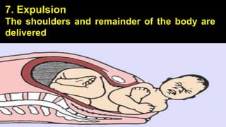 7. Expulsion
The shoulders and remainder of the body are
delivered
25
 