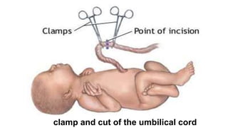 34
clamp and cut of the umbilical cord
 
