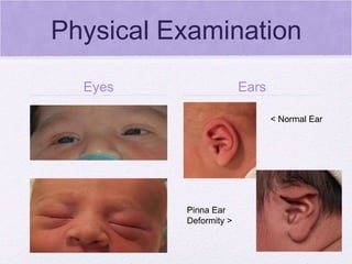 Physical Examination Eyes Ears < Normal Ear Pinna Ear Deformity > 