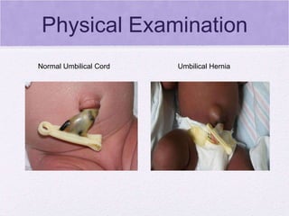 Physical Examination Normal Umbilical Cord  Umbilical Hernia  