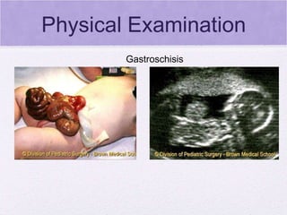 Physical Examination Gastroschisis  